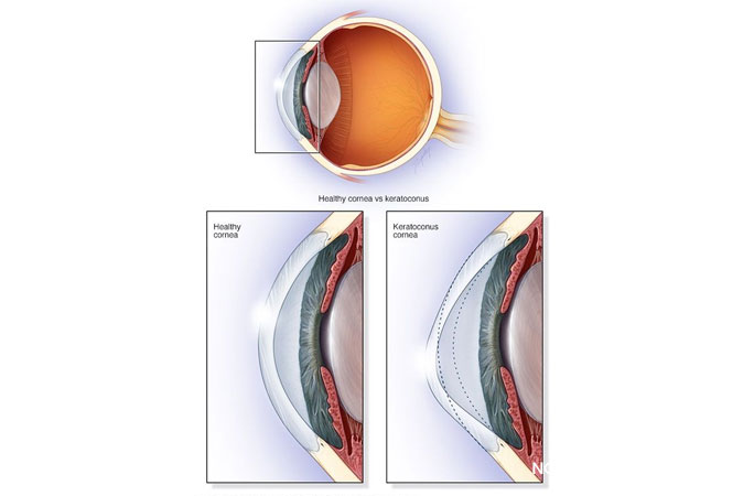 Who is Affected by Keratoconus?