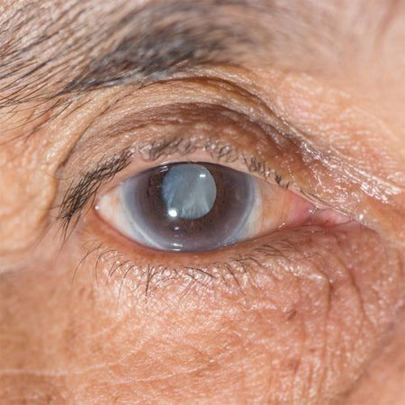 Cataract Surgery