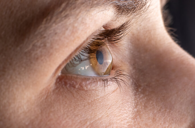 Corneal Diagnostics