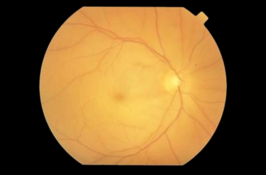 Central Retinal Artery Occlusion