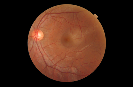 Central Serous Chorioretinopathy