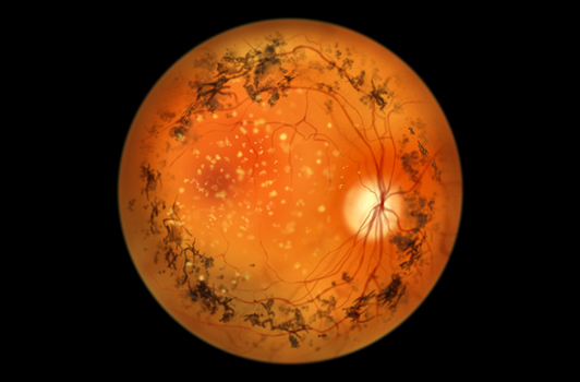 Retinitis Pigmentosa