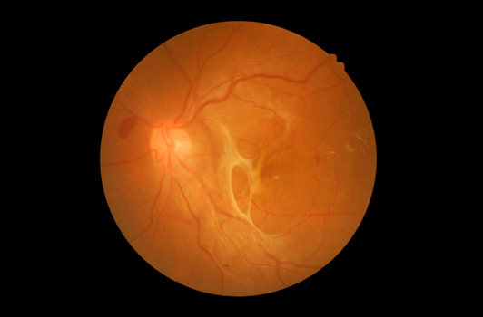 Retinal Tear