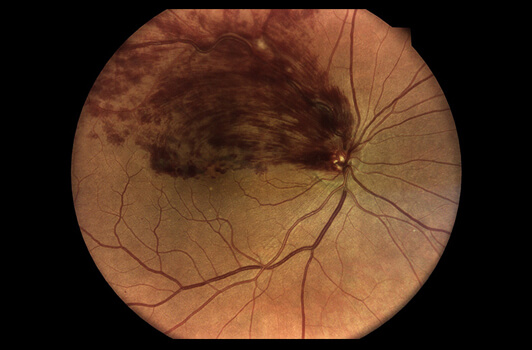 Retinal Vein Occlusion